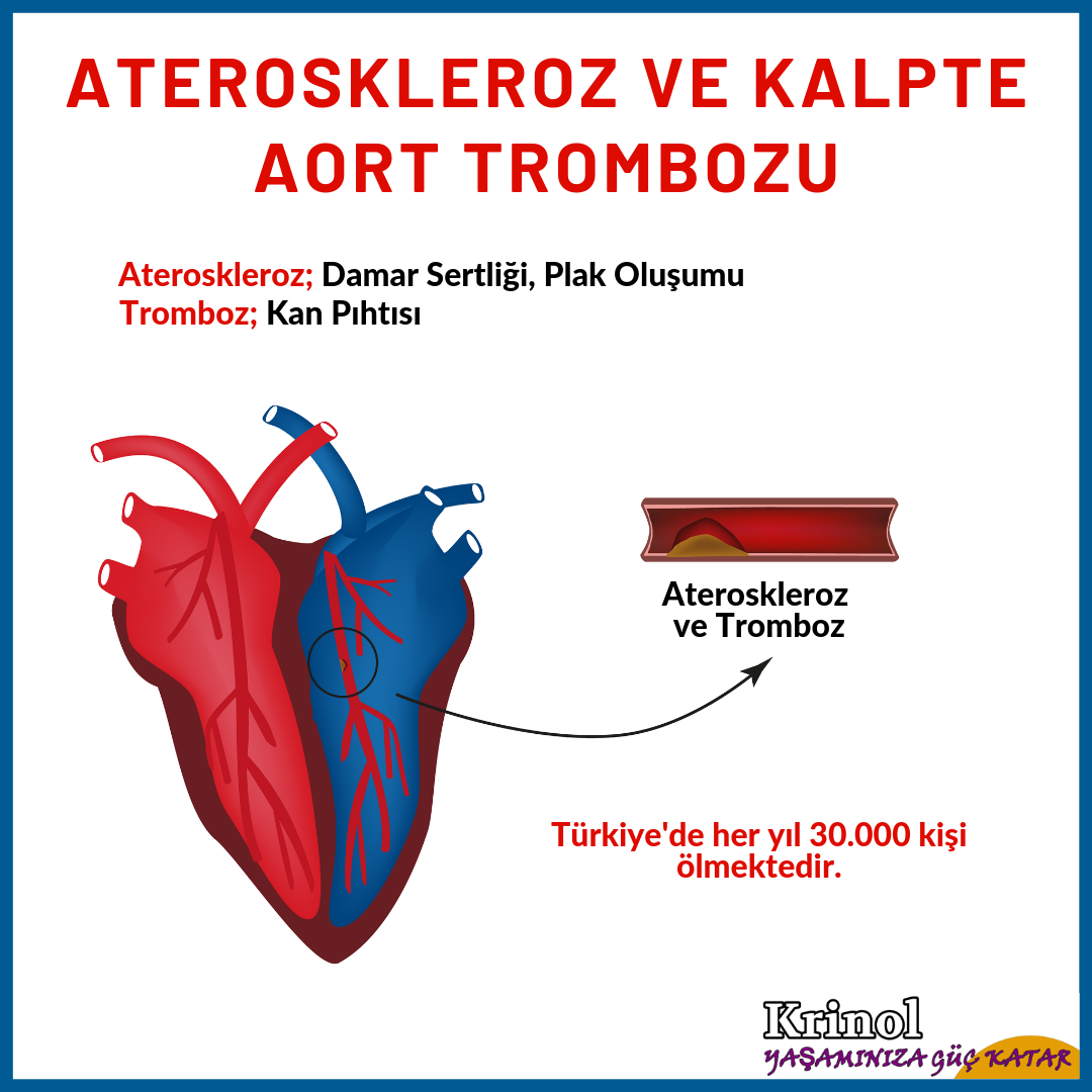 Ateroskleroz ve Kalpte Aort Trombozu Nedir?