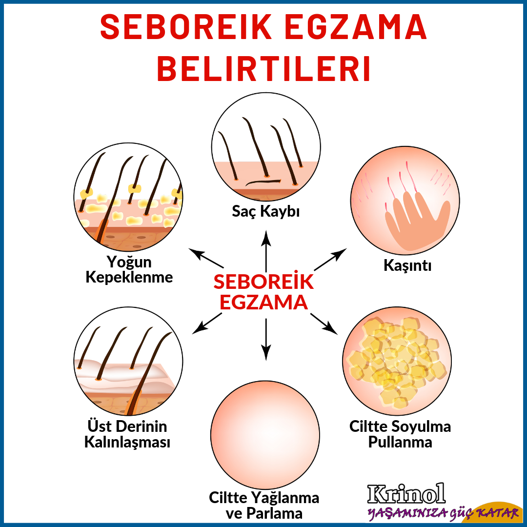 Seboreik Egzama Belirtileri Nelerdir?