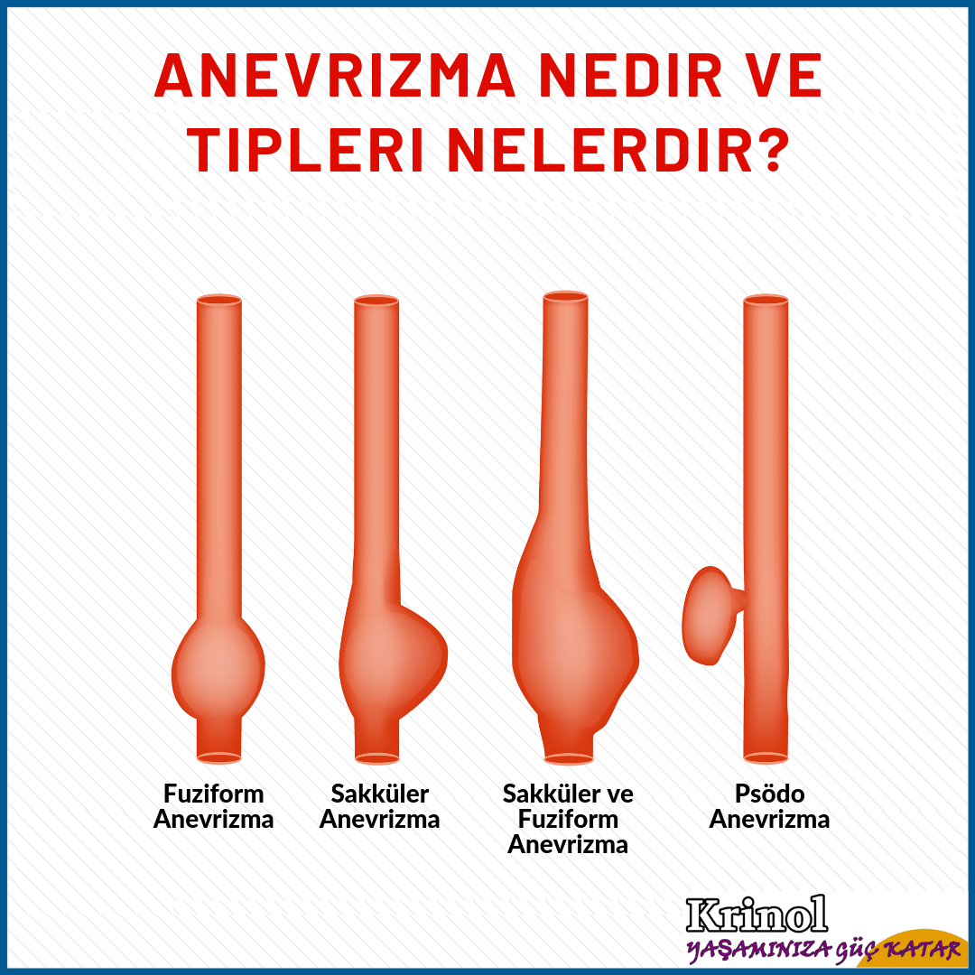 Anevrizma Nedir ve Tipleri Nelerdir?