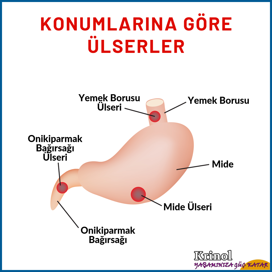 Konumlarına Göre Ülserler Nelerdir?