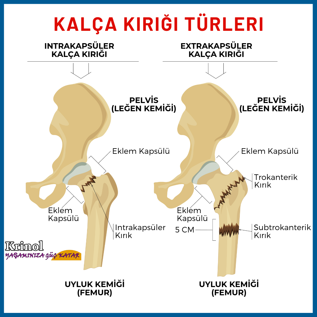 Kalça Kırığı Türleri Nelerdir?
