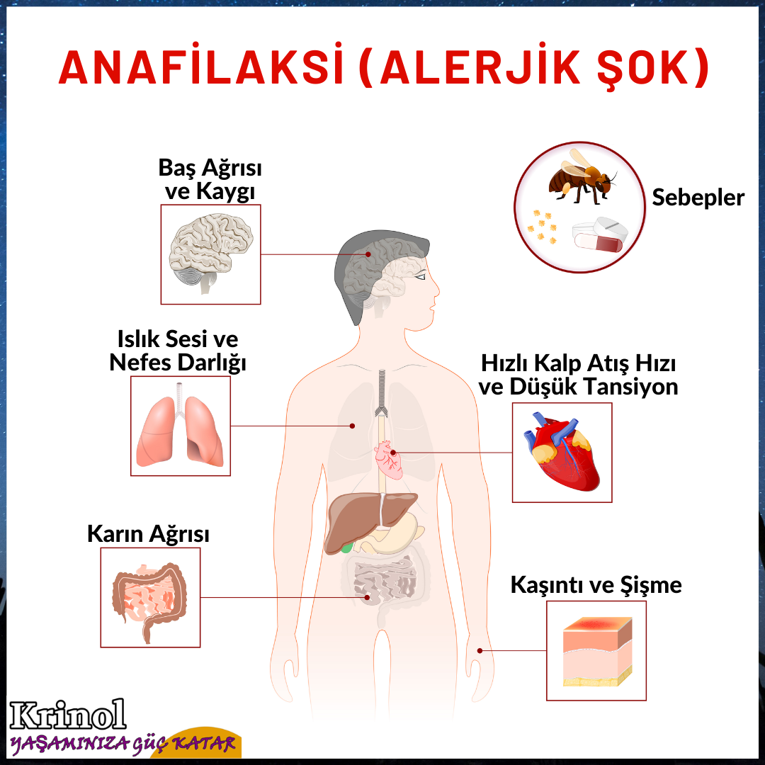 Anafilaksi (Alerjik Şok) Nedir?