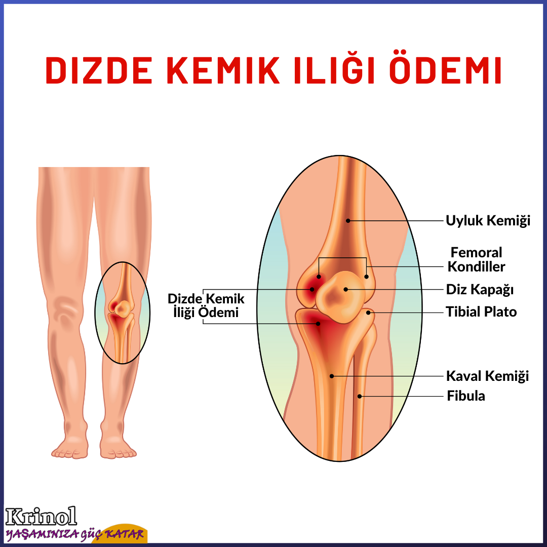 Dizde Kemik İliği Ödemi Nedir?
