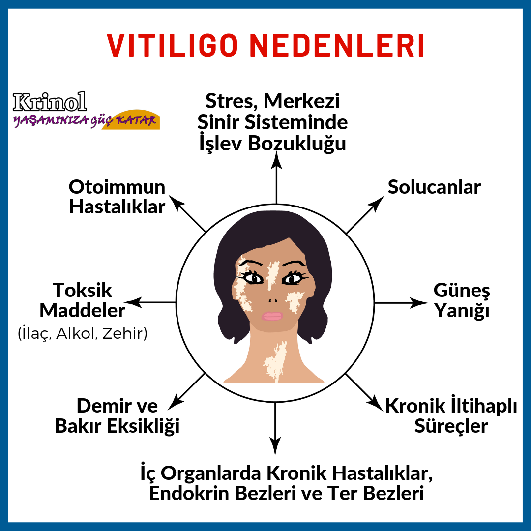 Vitiligo Nedenleri Nelerdir?