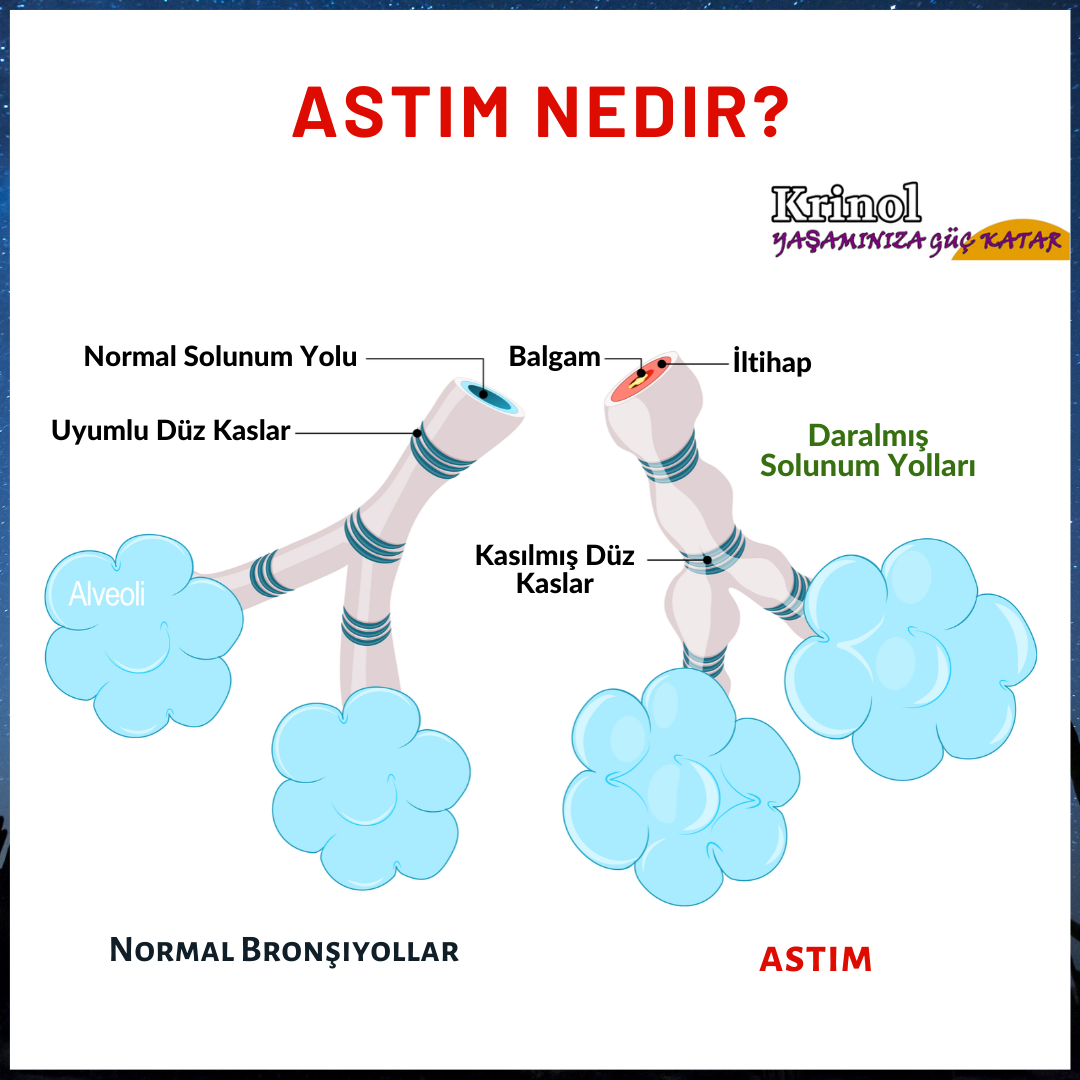 Astım Nedir?