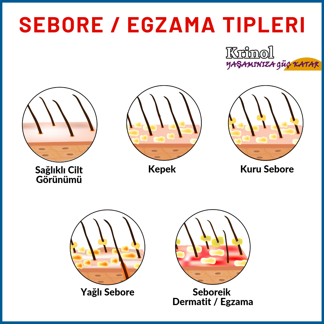 Sebore / Egzama Tipleri Nelerdir?
