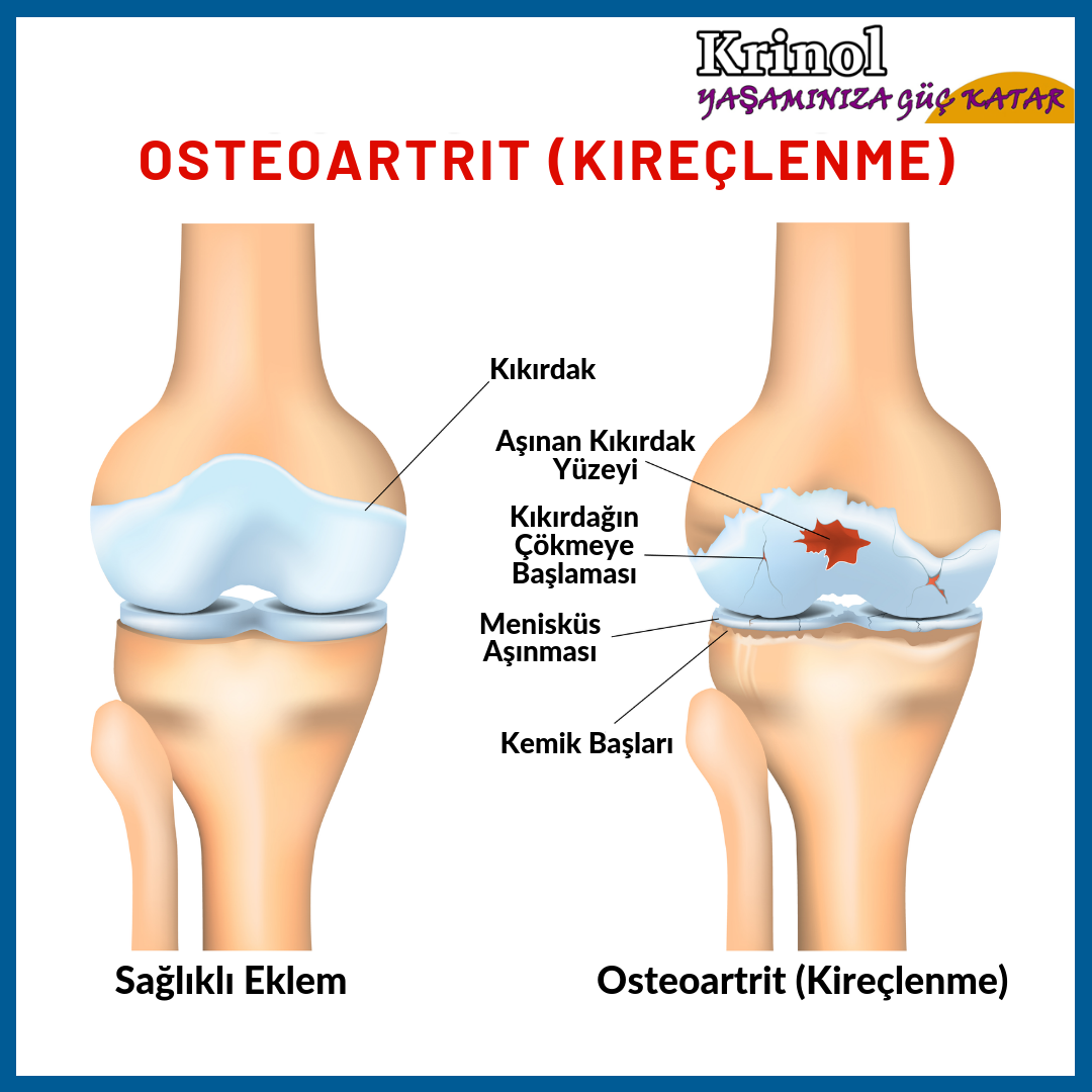 Osteoartrit (Kireçlenme) Nedir?