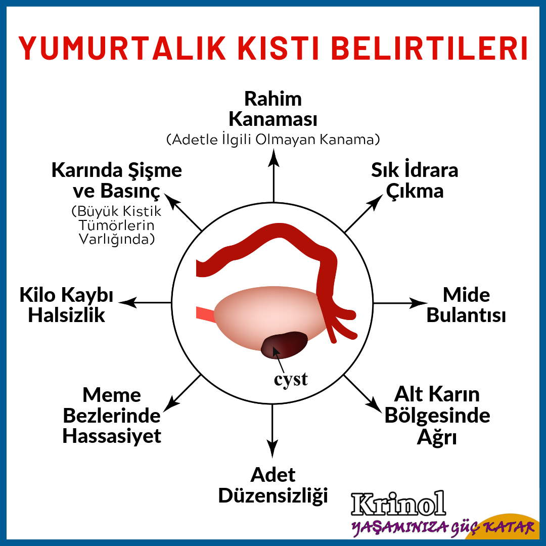 Yumurtalık Kisti Belirtileri Nelerdir?