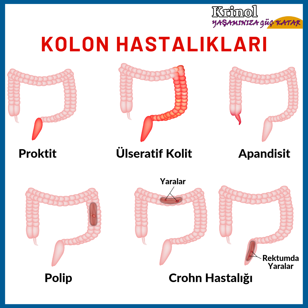 Kolon Hastalıkları Nelerdir?