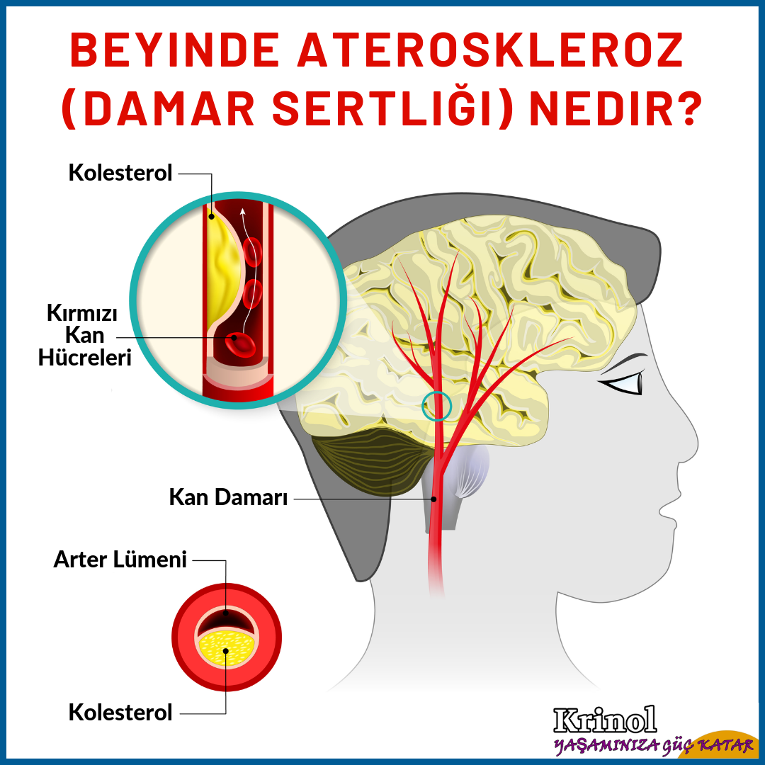 Beyinde Ateroskleroz (Damar Sertliği) Nedir?