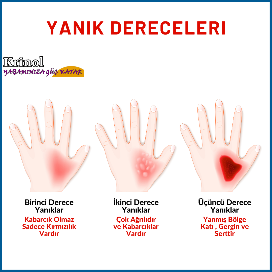 Yanık Dereceleri Nelerdir?