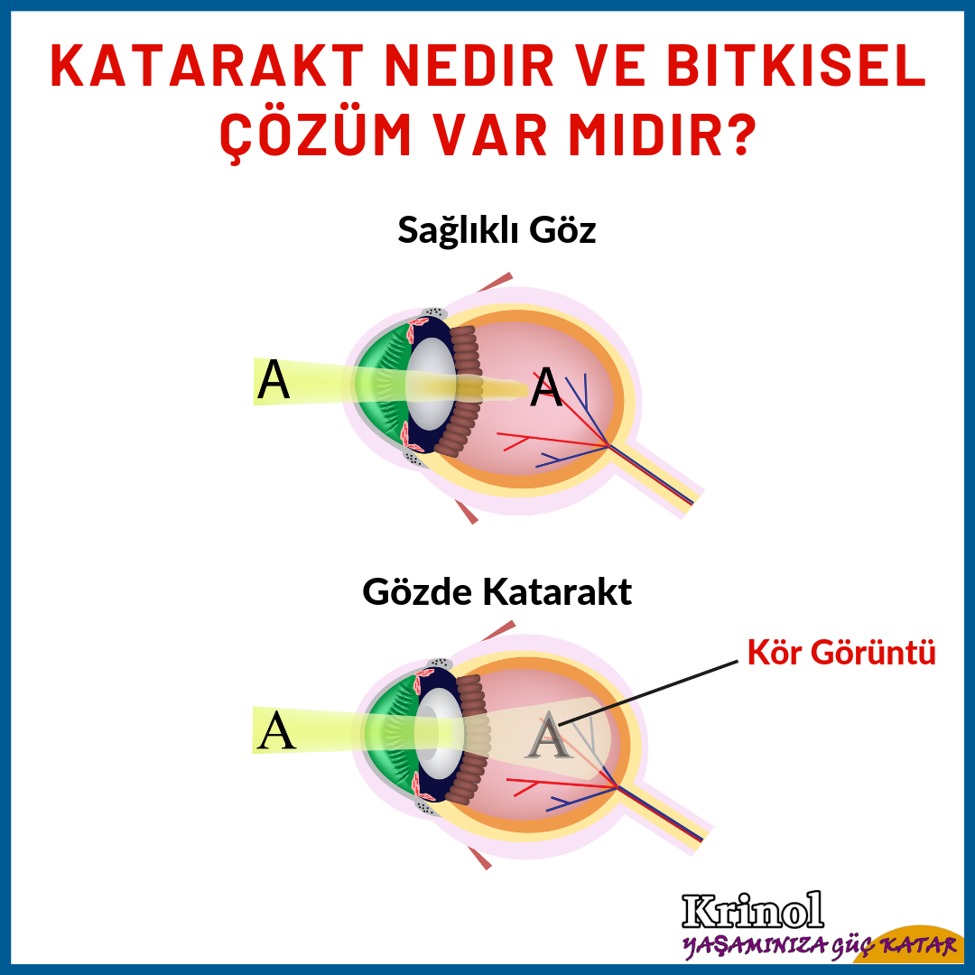 Katarakt Nedir ve Bitkisel Çözüm Var mıdır?