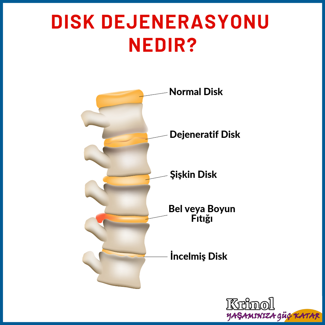 Disk Dejenerasyonu Nedir?