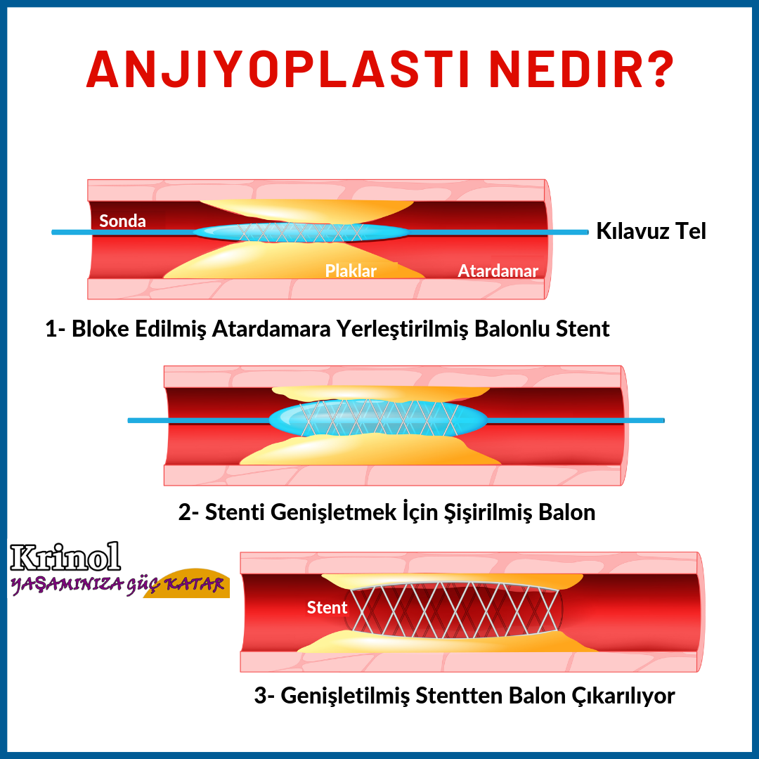Anjiyoplasti Nedir?