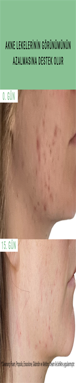 Etat Pur Pure Active Propolis Akne Karşıtı Saf Konsantre Bakım Serumu 15 ml