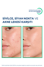 Sebium Kerato+ Cover Sivilce, Akne Lekesi Karşıtı Renkli Nemlendirici Krem 30 ml