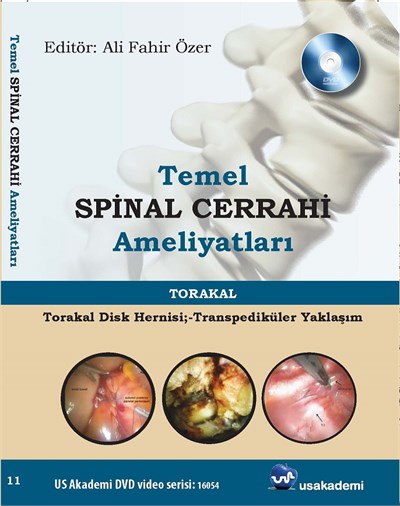 Temel Spinal Cerrahi Ameliyatları  Torakal disk hernisi; - transpediküler yaklaşım