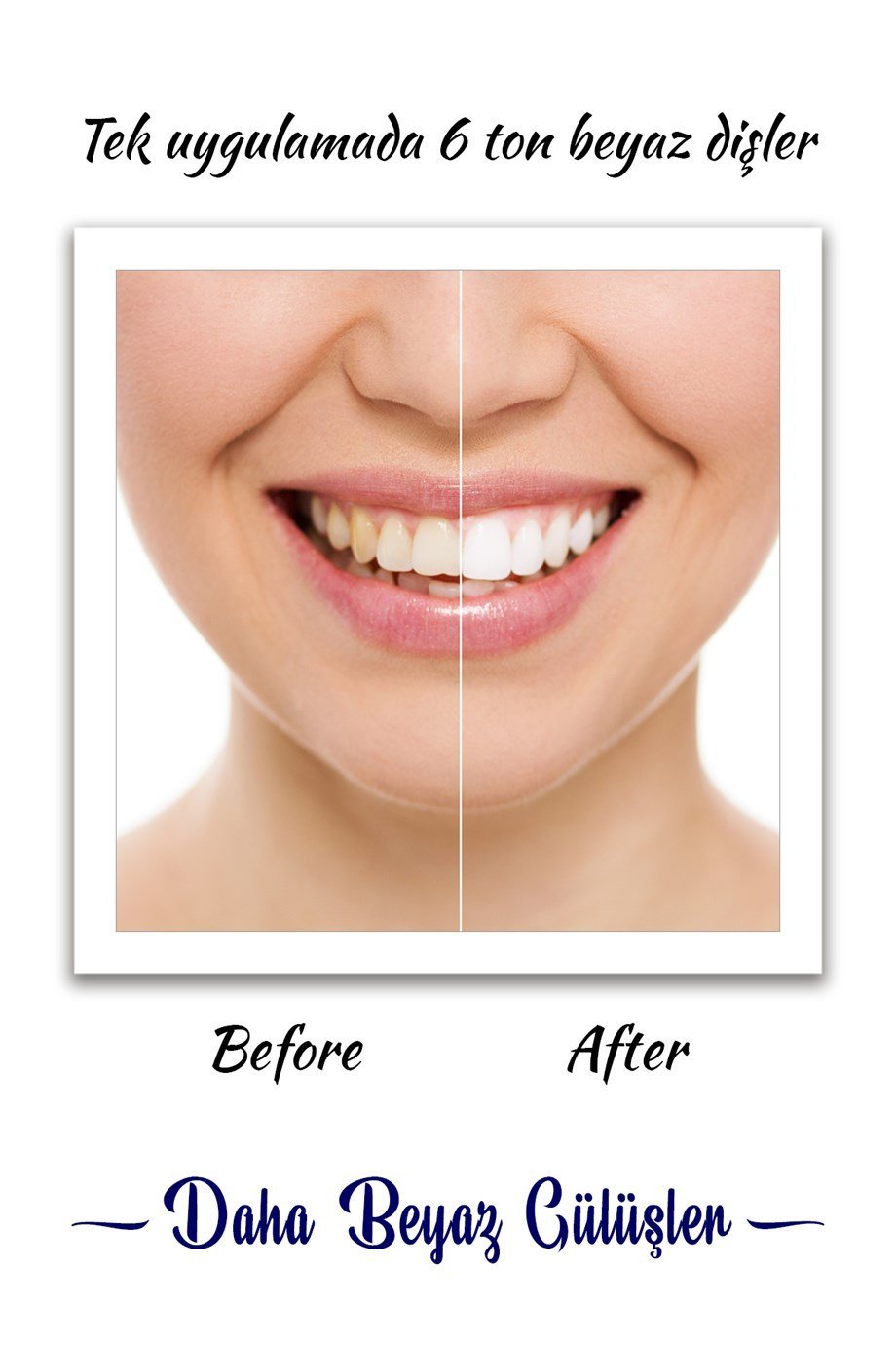 Deenthal Pro Diş Beyazlatıcı Set 6 Ton Diş Beyazlatma Seti Instant  Whitening Kit