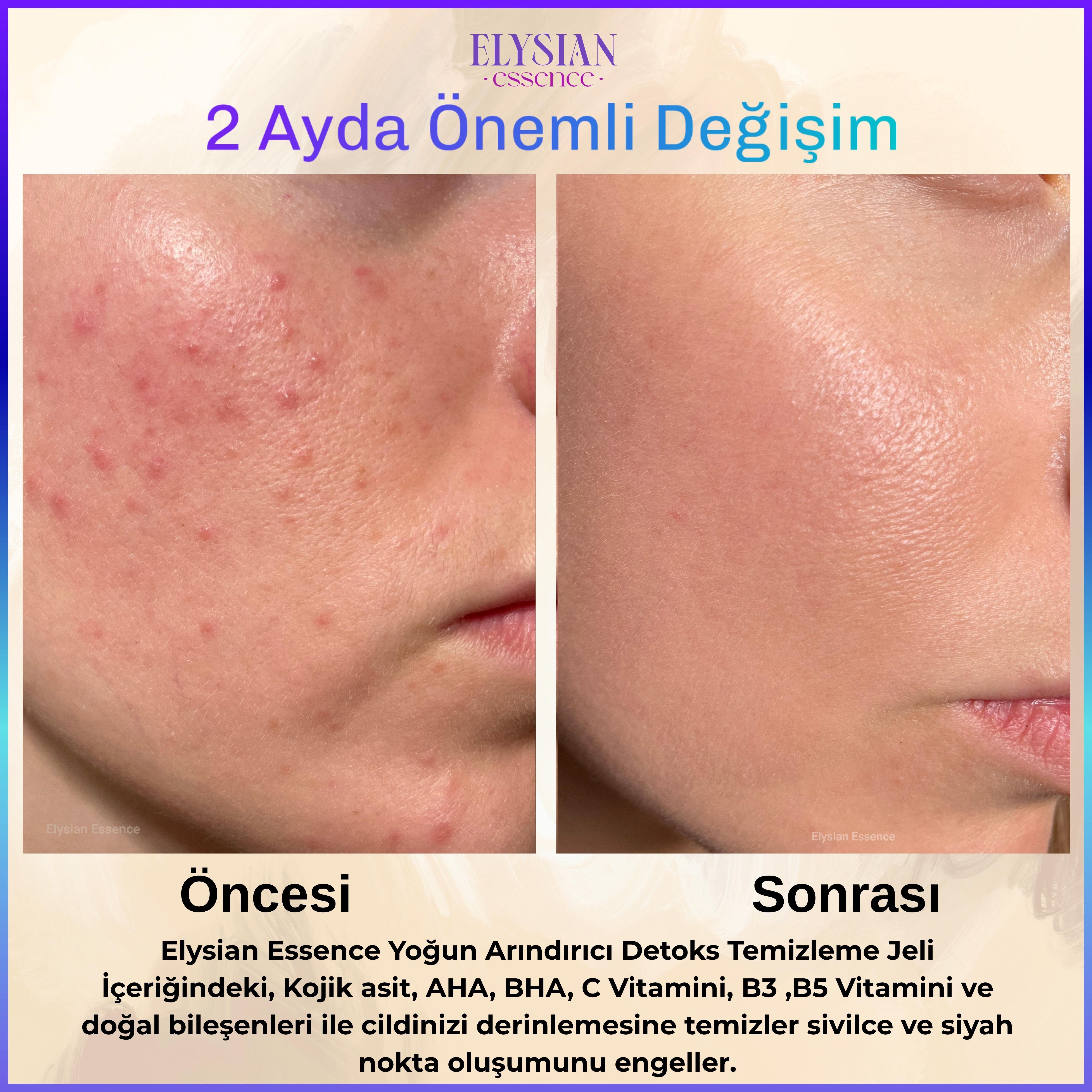 Elysian Essence Yoğun Arındırıcı Detoks Yüz Temizleme Jeli - Sivilce ve Siyah Nokta Karşıtı - AHA BHA - Kojik Asit 200 ml