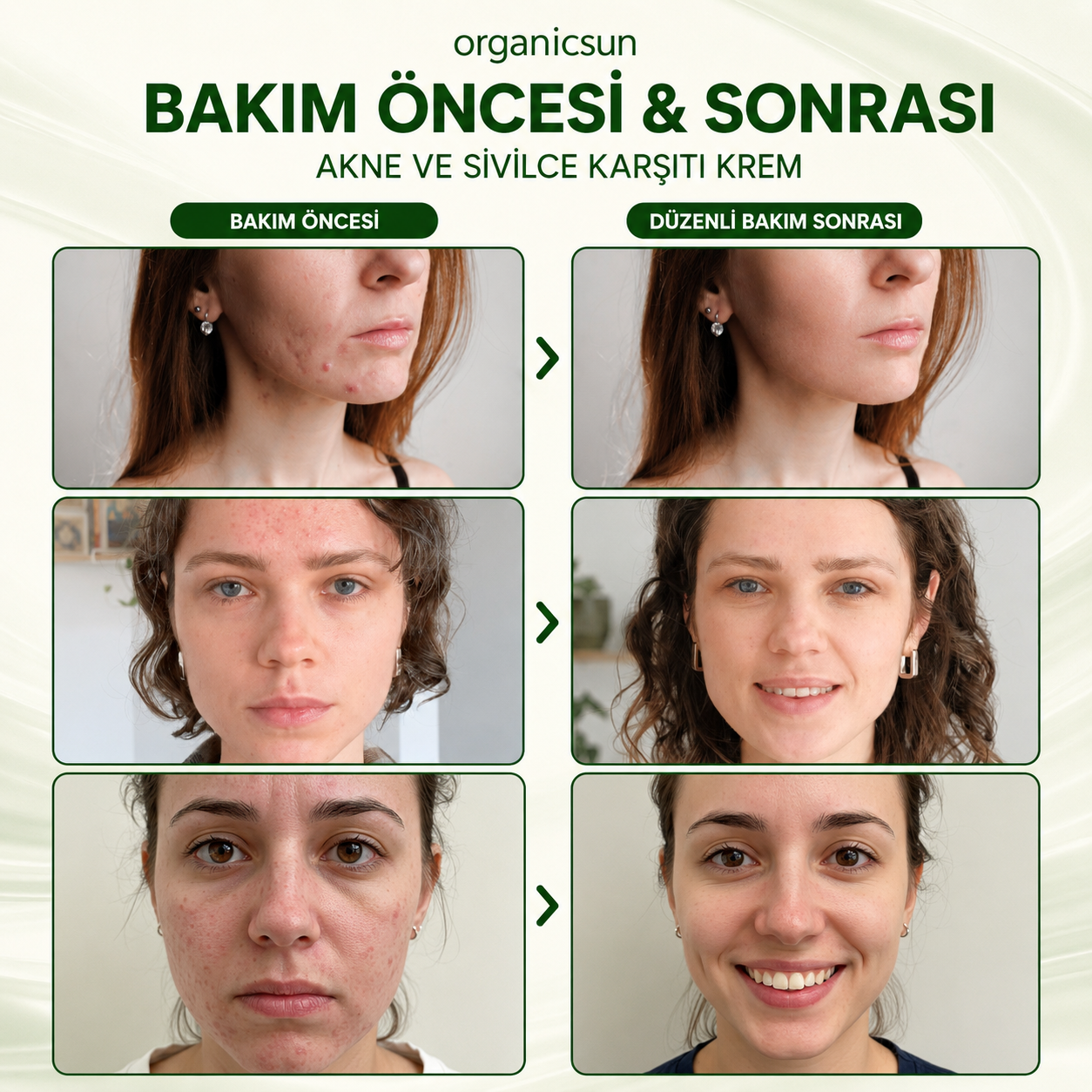 Organicsun Çay Ağacı ve Propolisli Akne ve Sivilce Karşıtı Cilt Bakım Kremi – Siyah Nokta ve Leke Görünümü Bakımı 50 ml