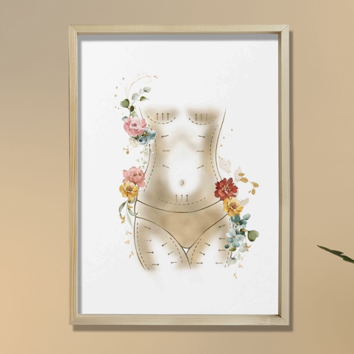 Anne Estetiği, Karın Germe, Liposuction, Plastik ve Estetik Cerrahı, Doktor Odası Duvar Tablosu