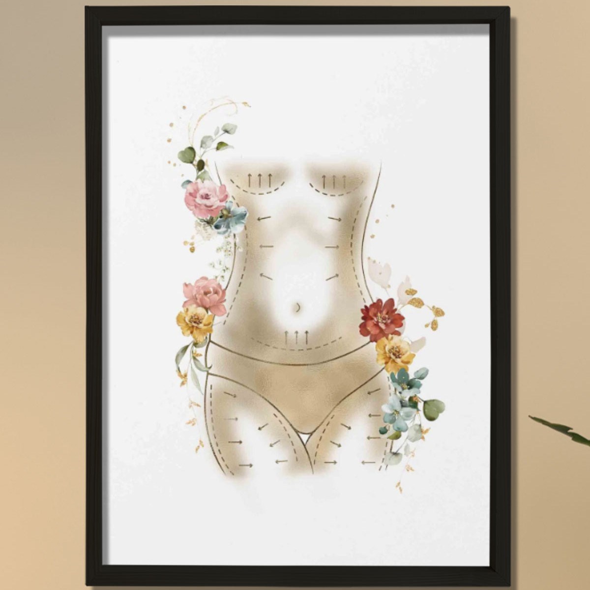 Anne Estetiği, Karın Germe, Liposuction, Plastik ve Estetik Cerrahı, Doktor Odası Duvar Tablosu