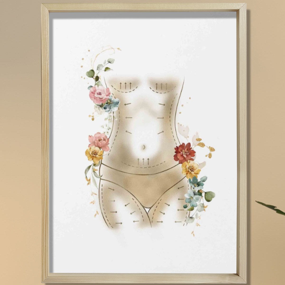 Anne Estetiği, Karın Germe, Liposuction, Plastik ve Estetik Cerrahı, Doktor Odası Duvar Tablosu