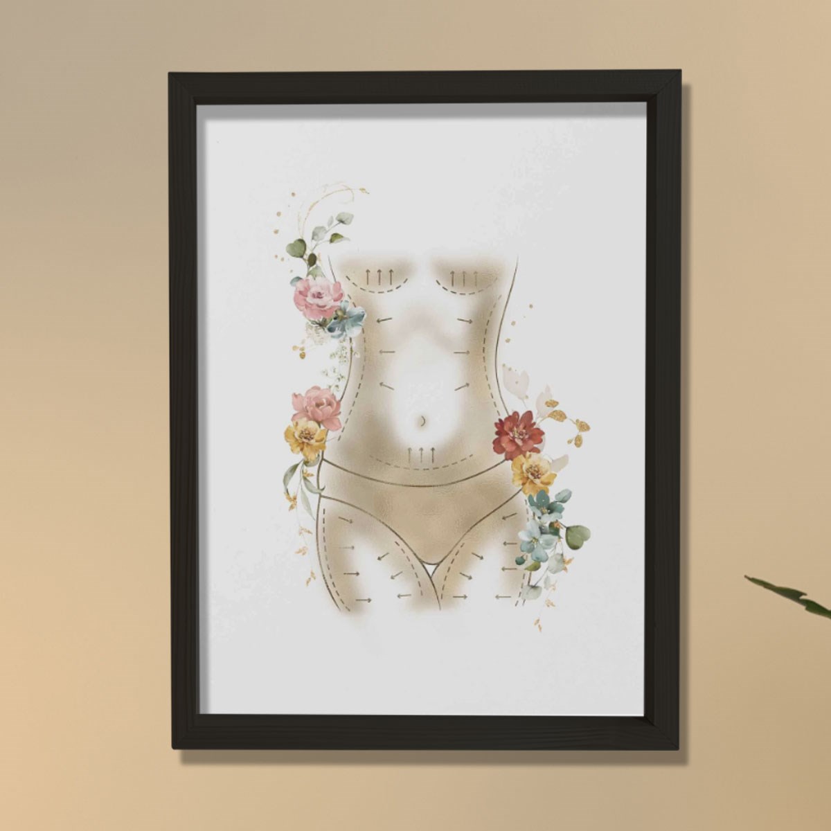 Anne Estetiği, Karın Germe, Liposuction, Plastik ve Estetik Cerrahı, Doktor Odası Duvar Tablosu