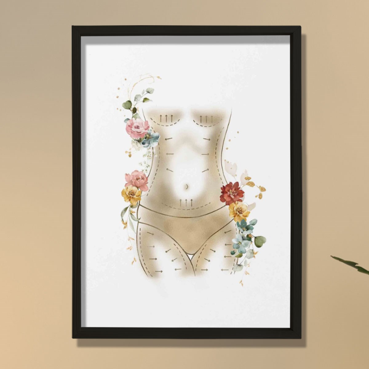 Anne Estetiği, Karın Germe, Liposuction, Plastik ve Estetik Cerrahı, Doktor Odası Duvar Tablosu