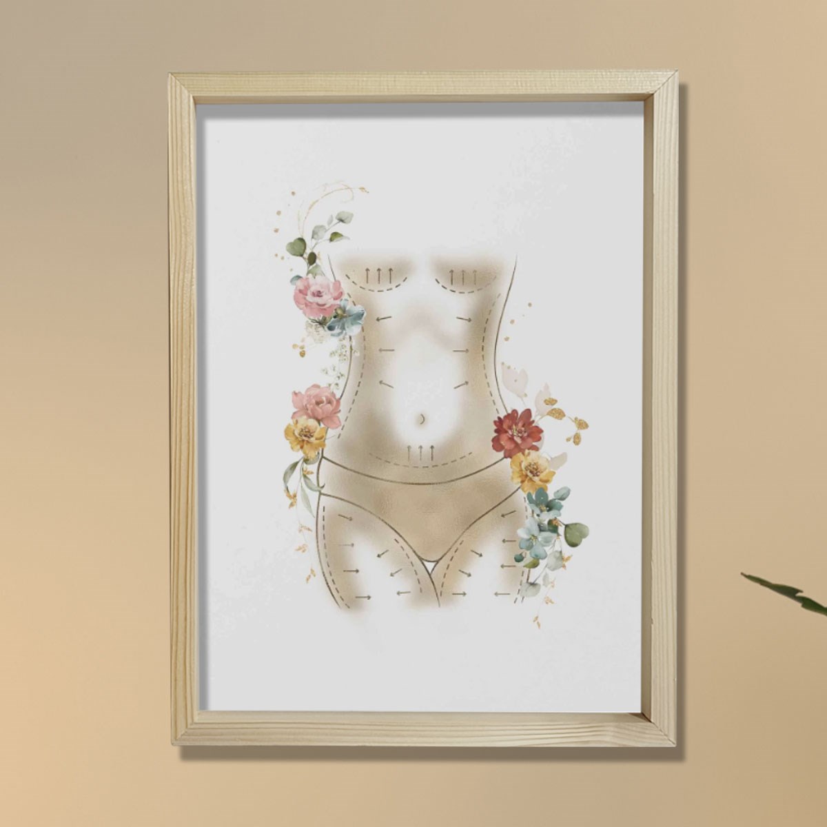 Anne Estetiği, Karın Germe, Liposuction, Plastik ve Estetik Cerrahı, Doktor Odası Duvar Tablosu