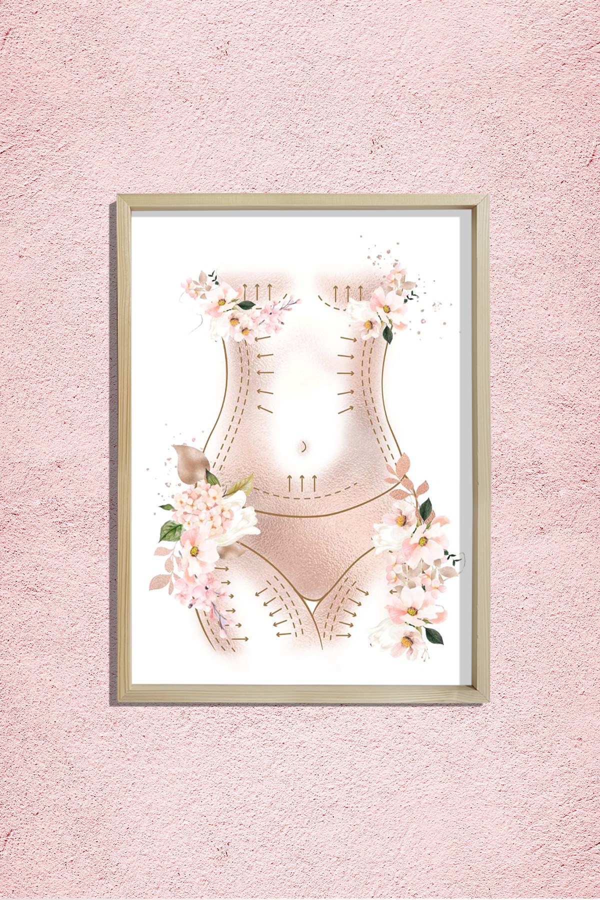 Anne Estetiği , Karın Germe Sanatı, Liposuction, Plastik ve Estetik Cerrahı, Doktor Odası Duvar Tablosu