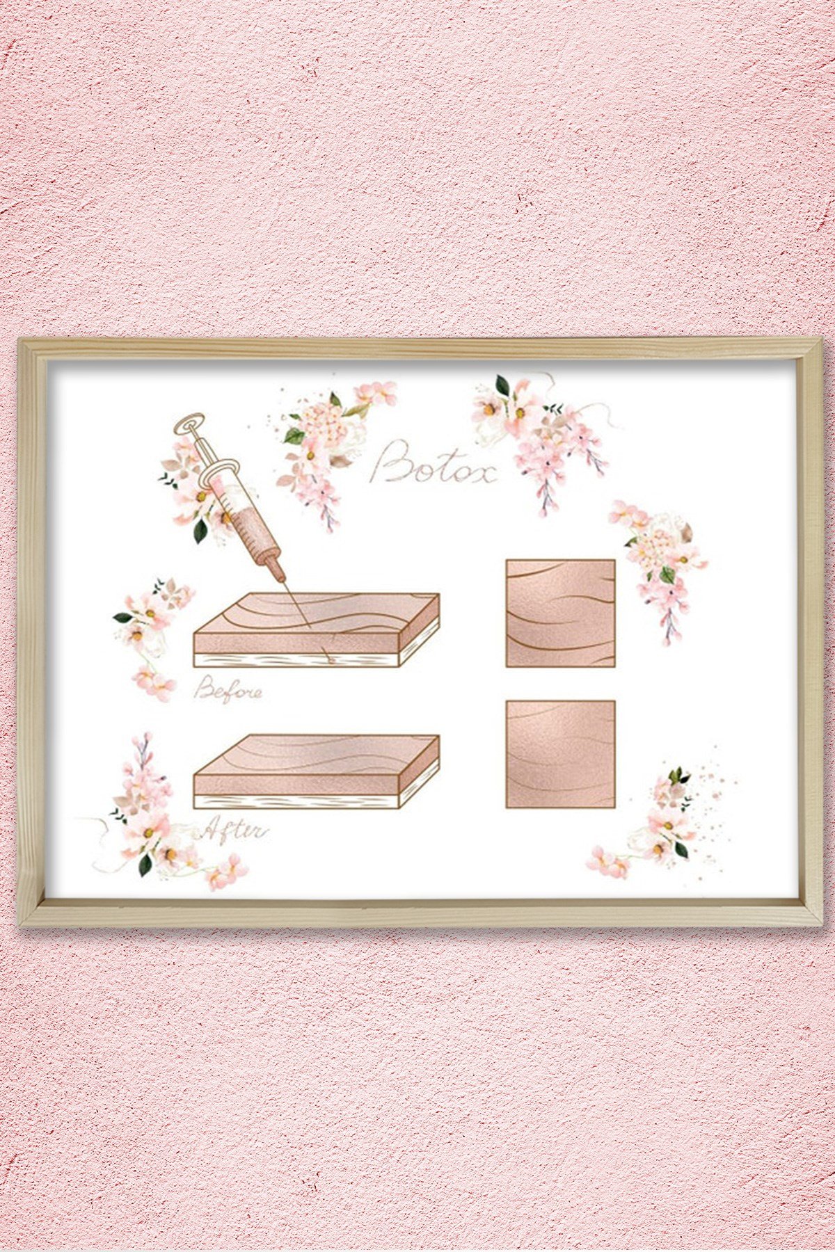 Botox Enjeksiyon Noktaları, Öncesi ve Sonrası, Plastik ve Estetik Cerrahı, Doktor Odası Duvar Tablosu