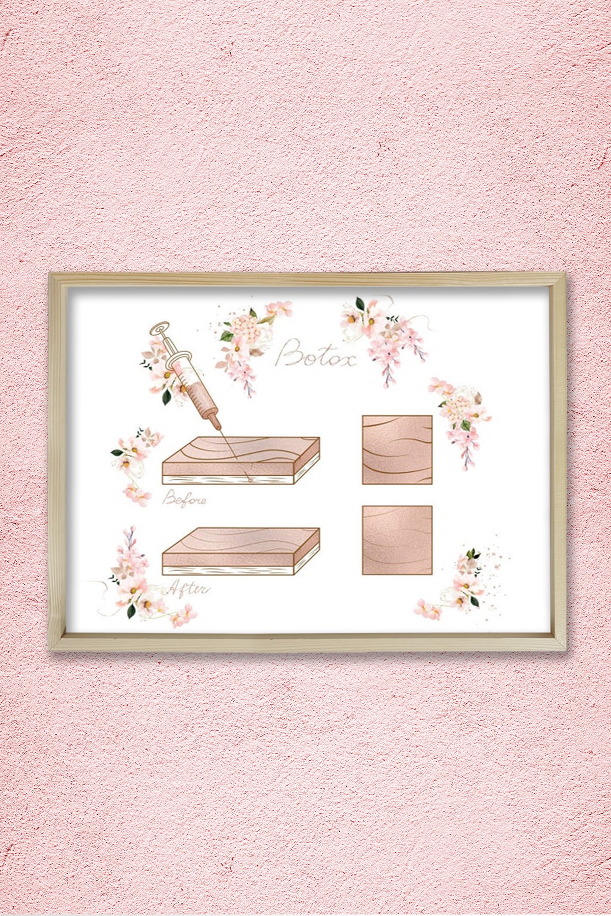 Botox Enjeksiyon Noktaları, Öncesi ve Sonrası, Plastik ve Estetik Cerrahı, Doktor Odası Duvar Tablosu