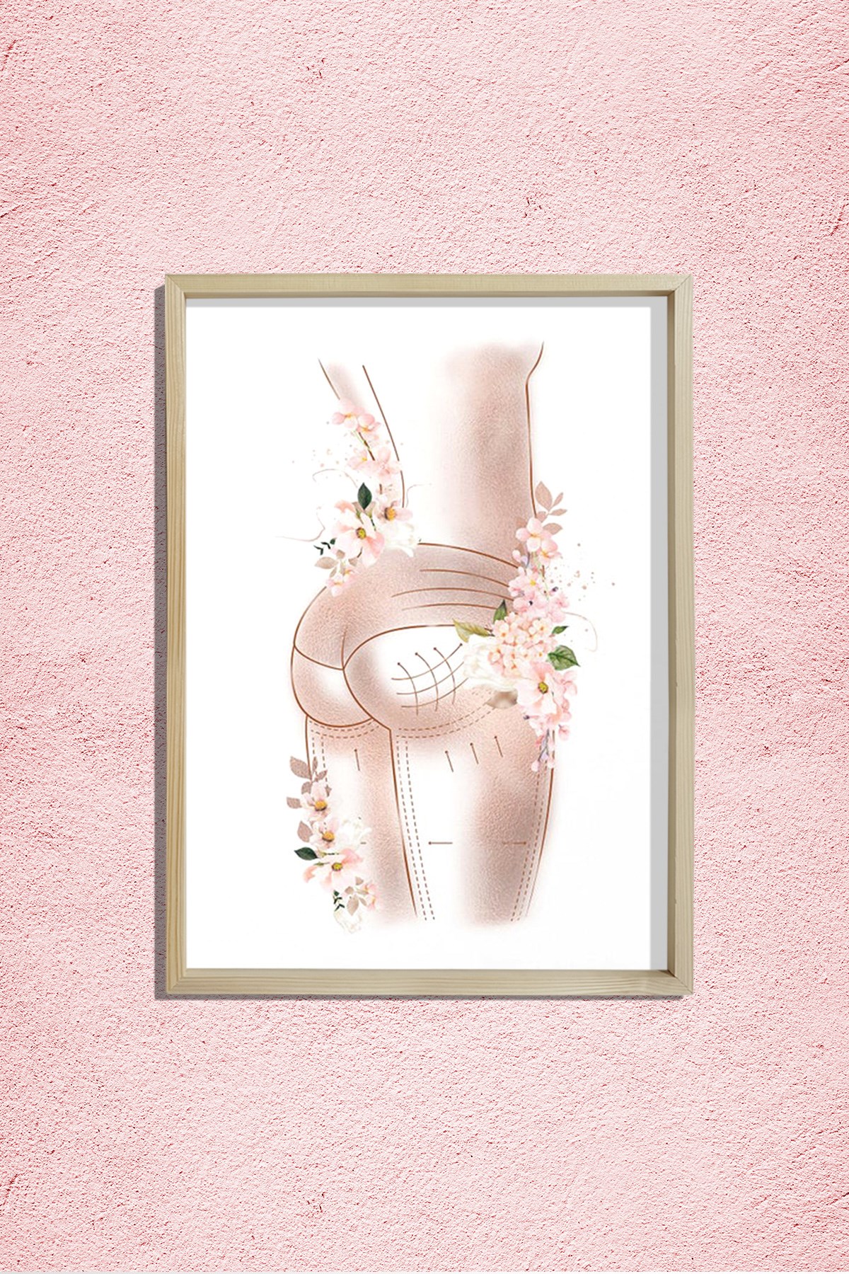 Breziya Poposu, Popo Kaldırma Sanatı, Plastik ve Estetik Cerrahı, Doktor Odası Duvar Tablosu