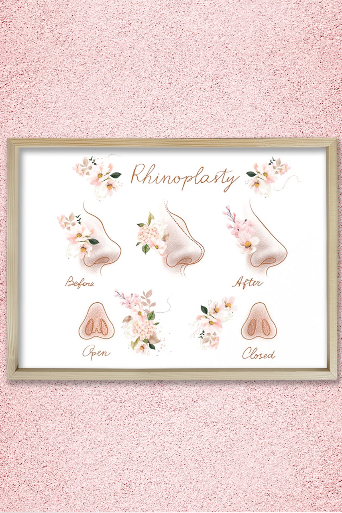 Burun Estetiği, Plastik ve Estetik Cerrahı, Doktor Odası Duvar Tablosu