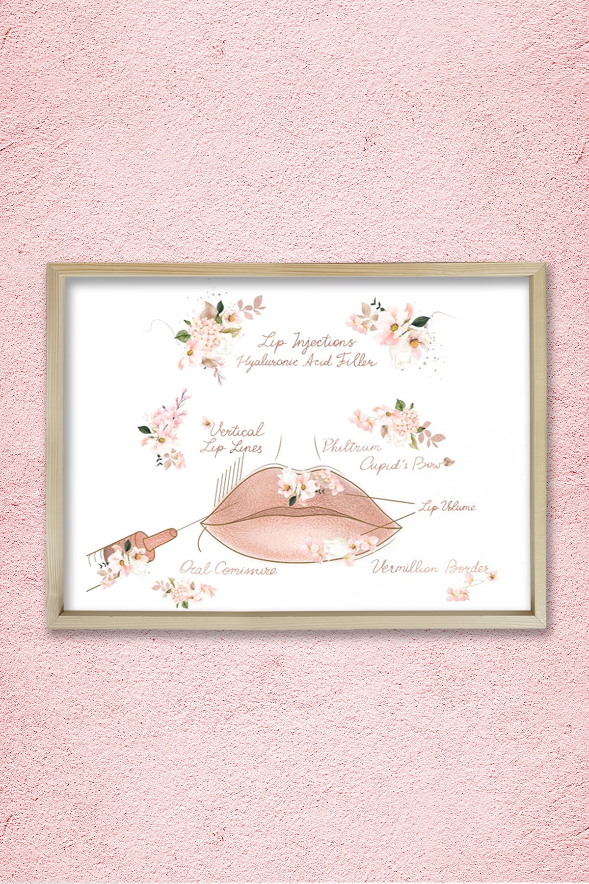 Dudak Dolgusu, Dudak Büyütme, Plastik ve Estetik Cerrahı, Doktor Odası Duvar Tablosu