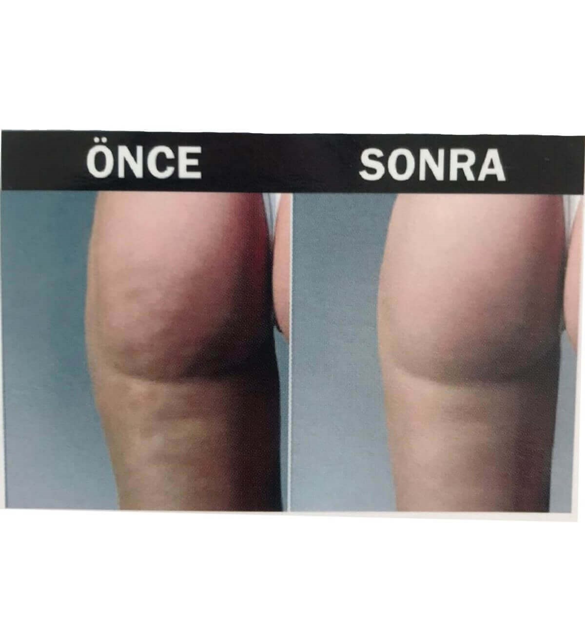 Hema Kadın Anti-Cellulite ( Selülit Giderici ) Masajlı Dikişsiz Paçalı Korse