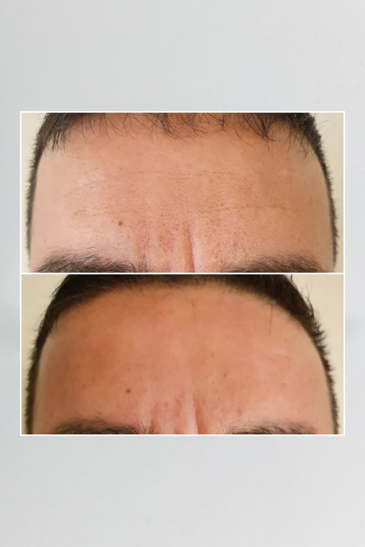 Pepplus+ Super Lifting - Face Lifting ve Sıkılaştırma Seti 4'lü | Pepplus