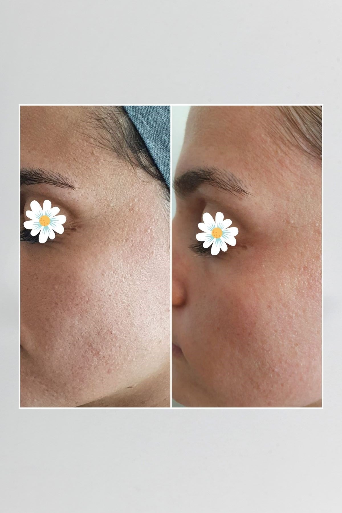Pepplus+ Super Lifting - Face Lifting ve Sıkılaştırma Seti 4'lü | Pepplus