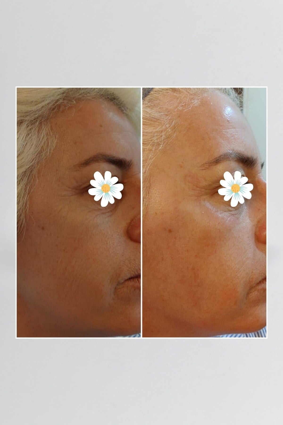 Pepplus+ Super Lifting - Face Lifting ve Sıkılaştırma Seti 4'lü | Pepplus