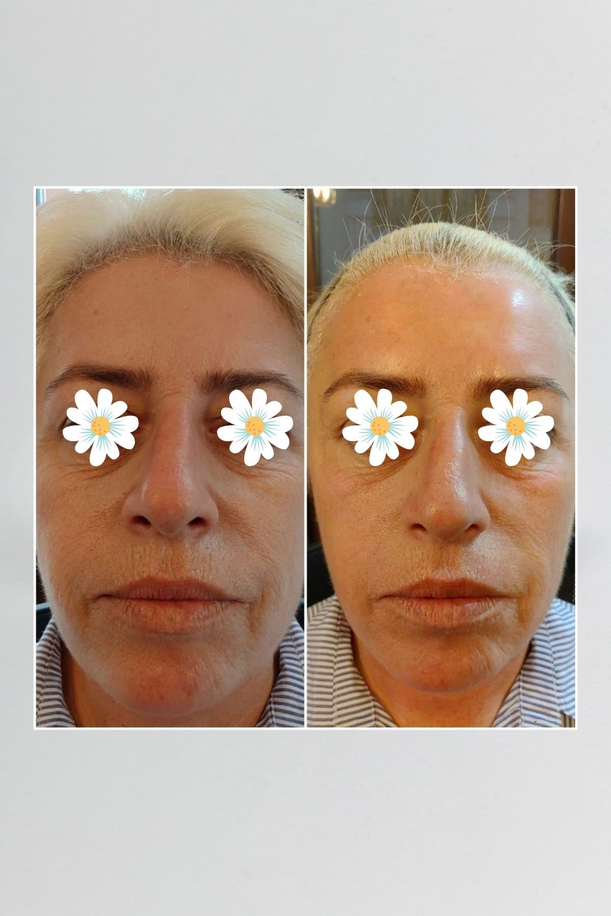 Pepplus+ Super Lifting - Face Lifting ve Sıkılaştırma Seti 4'lü | Pepplus