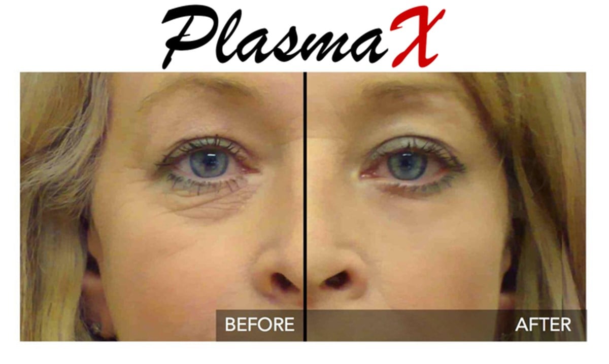 PlasmaX Pen Estetik Cihazı