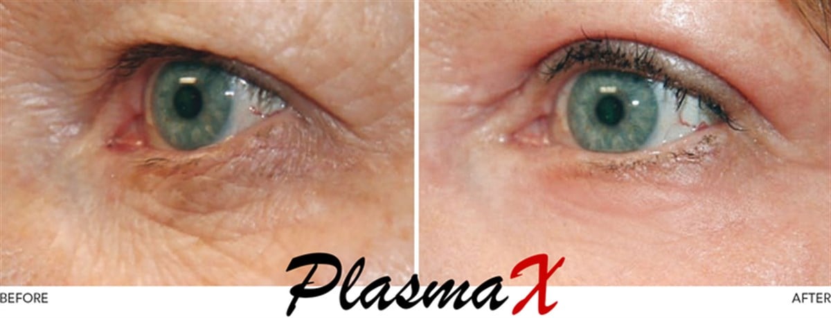 PlasmaX Pen Estetik Cihazı
