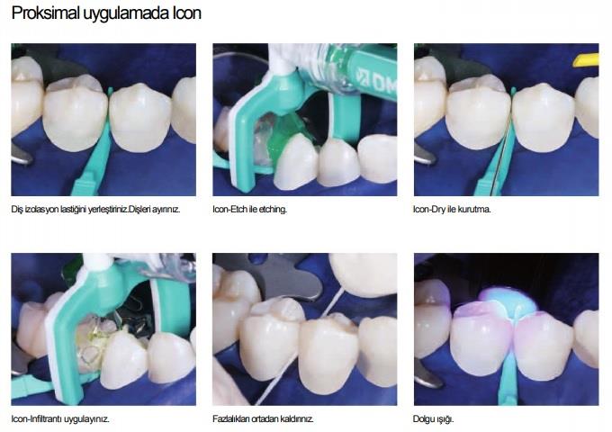 Dmg Icon Approximal Yüzeysel Çürük Tedavisi