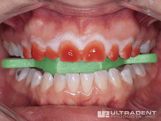 Ultradent İsoblock Isırma Bloğu