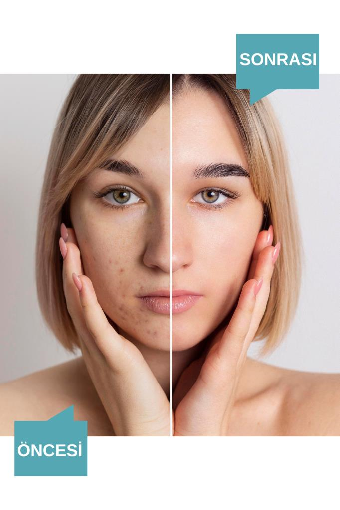 NOADERMA Noac Akne Karşıtı Tonik 200 ml