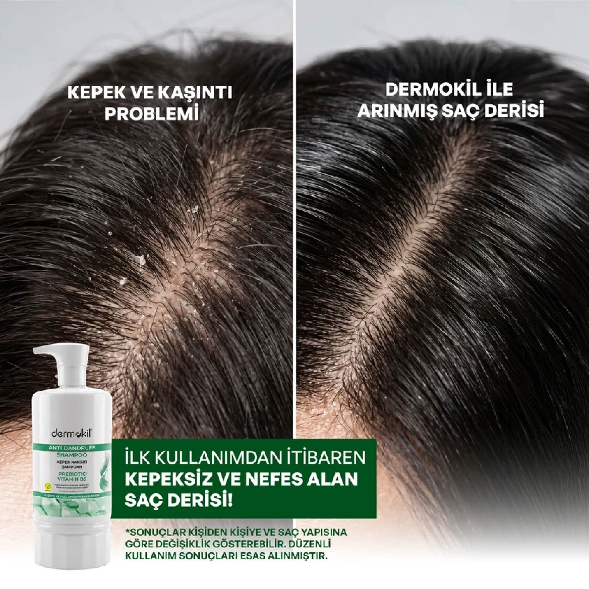 Dermokil Prebiyotik & Vitamin B5 Kepeğe Karşı Şampuan 950ml