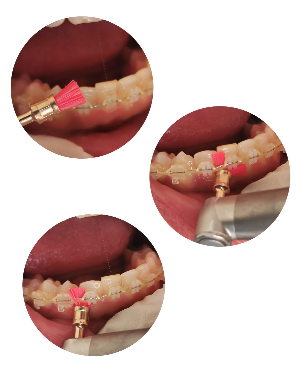 Pembe çok yumuşak (Sertlik 1) polisaj fırçası 5mm