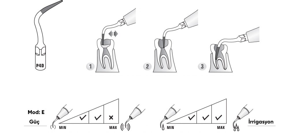 Woodpecker Endodonti Kavitron Ucu P4D Scaler Tips