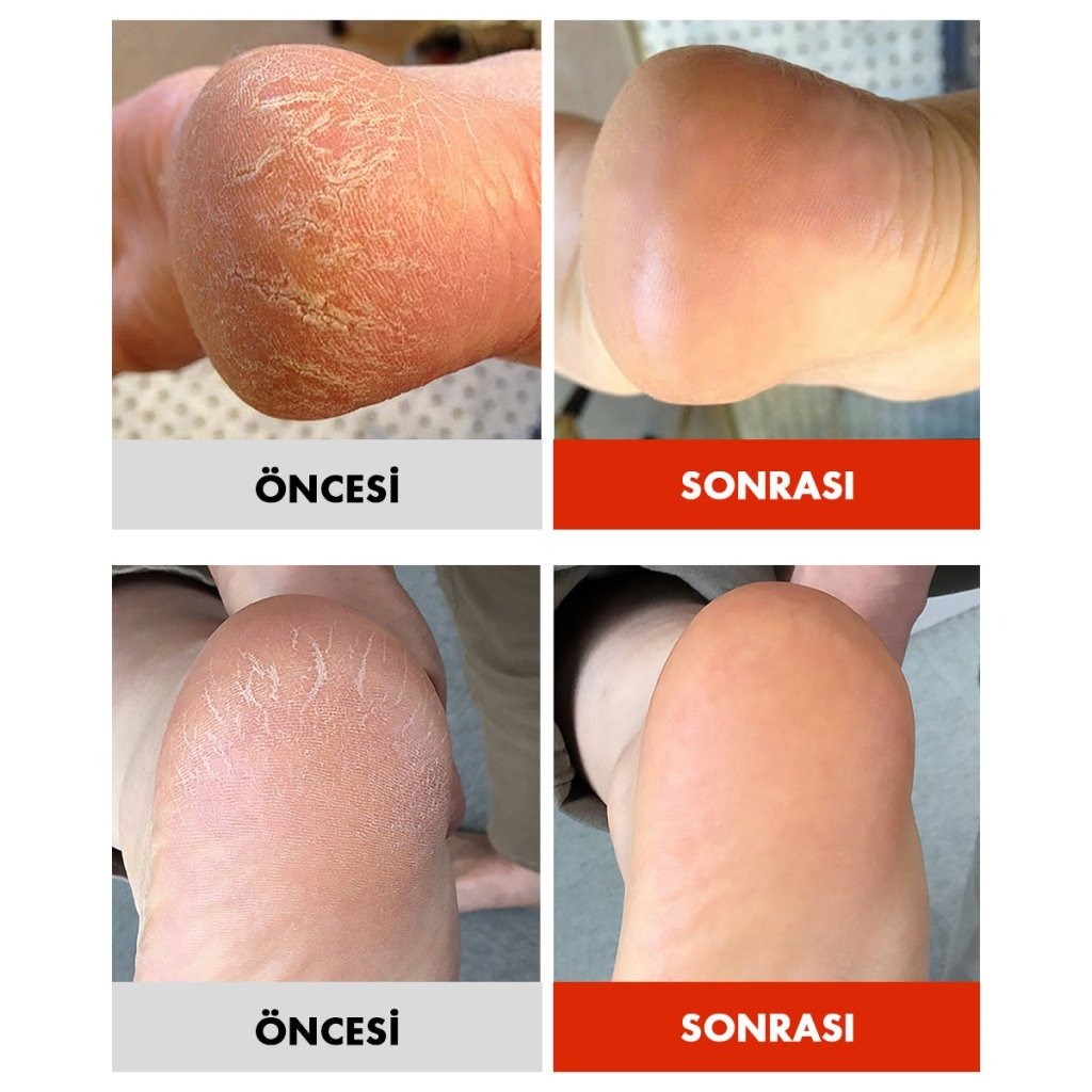 Sungboon Editor Cracked Heel Stick - Yoğun Topuk Bakım Sticki